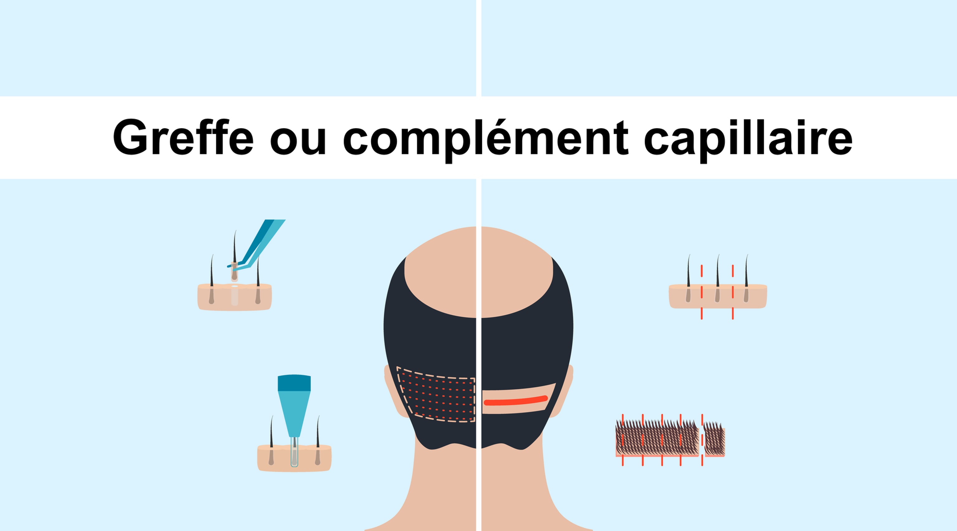 Implant ou complément capillaire